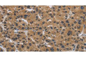 Immunohistochemistry of paraffin-embedded Human liver cancer tissue using Claudin 2 Polyclonal Antibody at dilution 1:50