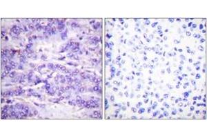 Immunohistochemistry analysis of paraffin-embedded human breast carcinoma, using MDM2 (Phospho-Ser166) Antibody. (MDM2 anticorps  (pSer166))