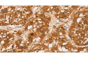 Immunohistochemistry of paraffin-embedded Human thyroid cancer tissue using CD43 Polyclonal Antibody at dilution 1:60