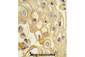 Formalin-fixed and paraffin-embedded human lung carcinomareacted with ROR1 polyclonal antibody , which was peroxidase-conjugated to the secondary antibody, followed by AEC staining. (ROR1 anticorps  (AA 112-399))