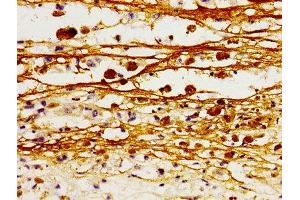 Immunohistochemistry of paraffin-embedded human melanoma using ABIN7161199 at dilution of 1:100 (L1CAM anticorps  (AA 995-1119))
