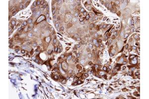 IHC-P Image Immunohistochemical analysis of paraffin-embedded SCC15 xenograft, using VPS16, antibody at 1:100 dilution. (VPS16 anticorps  (C-Term))