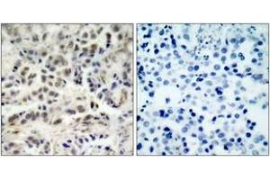 Immunohistochemistry analysis of paraffin-embedded human lung carcinoma tissue, using p27 Kip1 (Ab-10) Antibody.