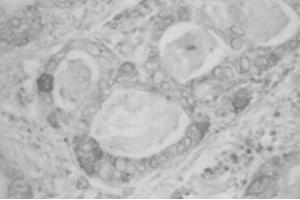 IHC on human uterine cervical adenocarcinoma (RCAS1 anticorps)