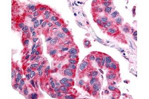 Anti-OR6N1 antibody IHC of human Lung, Non-Small Cell Carcinoma.