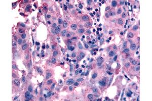 Anti-NANP antibody IHC of human Breast, Carcinoma. (NANP anticorps  (Internal Region))