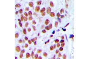 Immunohistochemical analysis of hnRNP L staining in human breast cancer formalin fixed paraffin embedded tissue section. (HNRNPL anticorps)