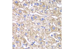 Immunohistochemistry of paraffin-embedded human liver injury using DLST antibody (ABIN6292010) at dilution of 1:100 (40x lens).