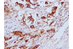 IHC image of ABIN7180656 diluted at 1:100 and staining in paraffin-embedded human gastric cancer performed on a Leica BondTM system.