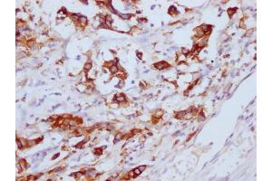 IHC image of ABIN7180656 diluted at 1:100 and staining in paraffin-embedded human gastric cancer performed on a Leica BondTM system. (CEACAM5 anticorps)