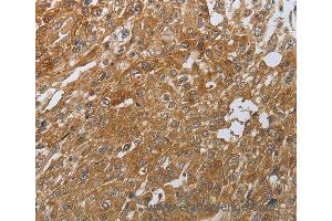 Immunohistochemistry of Human ovarian cancer using PTPRM Polyclonal Antibody at dilution of 1:80 (PTPRM anticorps)