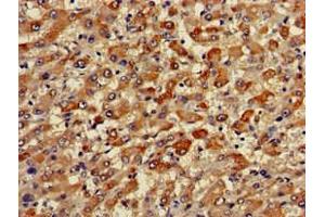 Immunohistochemistry of paraffin-embedded human liver cancer using ABIN7173471 at dilution of 1:100 (TRIM59 anticorps  (AA 126-181))