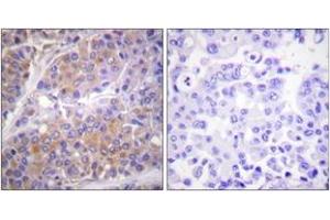 Immunohistochemistry analysis of paraffin-embedded human breast carcinoma, using p70 S6 Kinase (Phospho-Ser371) Antibody.