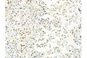 ABIN6266359 and ABIN6276704 at 1/100 staining Human lung cancer by IHC-P. (PRMT5 anticorps  (Internal Region))