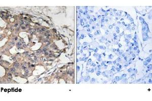 Immunohistochemical analysis of paraffin-embedded human breast carcinoma tissue using BRAF polyclonal antibody . (BRAF anticorps)