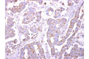 IHC-P Image Bif-1 antibody detects Bif-1 protein at cytosol on human ovarian carcinoma by immunohistochemical analysis. (ZBTB24 anticorps  (C-Term))