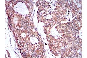 Immunohistochemical analysis of paraffin-embedded prostate cancer tissues using CSF1R mouse mAb with DAB staining. (CSF1R anticorps  (AA 344-497))
