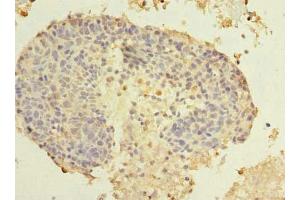 Immunohistochemistry of paraffin-embedded human cervical cancer using ABIN7173459 at dilution of 1:100 (TRIM51 anticorps  (AA 160-452))