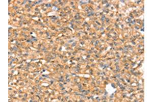 The image on the left is immunohistochemistry of paraffin-embedded Human prostate cancer tissue using ABIN7192491(SLC43A2 Antibody) at dilution 1/20, on the right is treated with synthetic peptide.