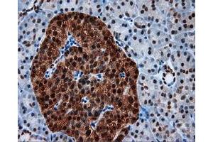 Immunohistochemical staining of paraffin-embedded Adenocarcinoma of colon tissue using anti-SIL1 mouse monoclonal antibody. (SIL1 anticorps)