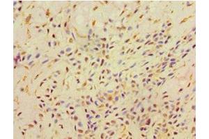 Immunohistochemistry of paraffin-embedded human breast cancer using ABIN7168521 at dilution of 1:100