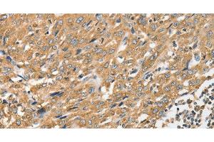 Immunohistochemistry of paraffin-embedded Human esophagus cancer tissue using ANGPTL7 Polyclonal Antibody at dilution 1:40 (ANGPTL7 anticorps)