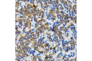 Immunohistochemistry of paraffin-embedded human thyroid cancer using Thyroid Peroxidase Rabbit mAb (ABIN7270865) at dilution of 1:100 (40x lens). (TPO anticorps)