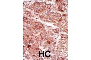 Formalin-fixed and paraffin-embedded human cancer tissue reacted with the primary antibody, which was peroxidase-conjugated to the secondary antibody, followed by AEC staining.
