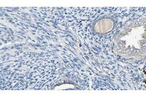 ABIN6272591 at 1/100 staining Human cervical cancer tissue by IHC-P. (IFI6 anticorps)