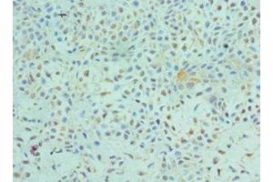 Immunohistochemistry of paraffin-embedded human breast cancer using ABIN7172544 at dilution of 1:100