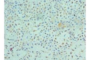 Immunohistochemistry of paraffin-embedded human breast cancer using ABIN7172544 at dilution of 1:100 (ETV6 anticorps  (AA 1-300))