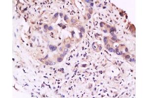 Formalin-fixed and paraffin embedded human gastric carcinoma labeled with Anti-IL-23R Polyclonal Antibody, Unconjugated  at 1:200 followed by conjugation to the secondary antibody and DAB staining (IL23R anticorps  (AA 401-550))