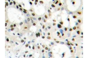 Immunohistochemistry analyzes of hnRNP A1 antibody in paraffin-embedded human liver carcinoma tissue. (HNRNPA1 anticorps)