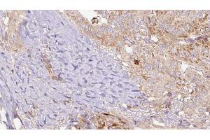 ABIN6267169 at 1/100 staining Human thyroid cancer tissue by IHC-P. (REPS1 anticorps  (pSer709))