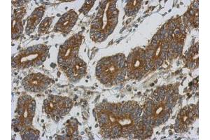 IHC-P Image Immunohistochemical analysis of paraffin-embedded human colon carcinoma, using ETFA, antibody at 1:500 dilution. (ETFA anticorps  (Center))