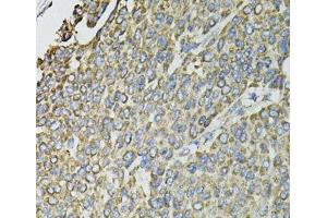 Immunohistochemistry of paraffin-embedded Human liver cancer using RASSF1 Polyclonal Antibody at dilution of 1:100 (40x lens). (RASSF1 anticorps)