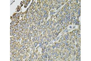 Immunohistochemistry of paraffin-embedded Human liver cancer using RASSF1 Polyclonal Antibody at dilution of 1:100 (40x lens).