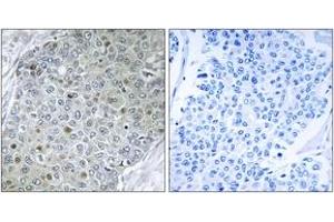Immunohistochemistry analysis of paraffin-embedded human breast carcinoma tissue, using ETV4 Antibody. (ETV4 anticorps  (AA 281-330))