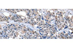 Immunohistochemistry of paraffin-embedded Human breast cancer tissue using ZFP2 Polyclonal Antibody at dilution of 1:40(x200)