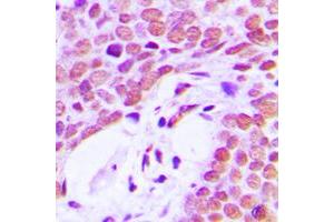 Immunohistochemical analysis of Ku80 staining in human breast cancer formalin fixed paraffin embedded tissue section.