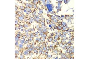 Immunohistochemistry of paraffin-embedded human esophageal cancer using GLUD2 antibody at dilution of 1:100 (x40 lens). (GLUD2 anticorps)