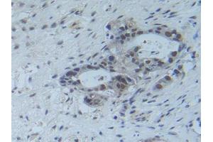 IHC-P analysis of Human Pancreas Cancer Tissue, with DAB staining. (RFTN1 anticorps  (AA 288-520))