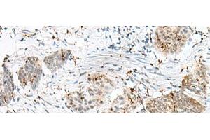 Immunohistochemistry of paraffin-embedded Human esophagus cancer tissue using PLCL2 Polyclonal Antibody at dilution of 1:50(x200) (PLCL2 anticorps)