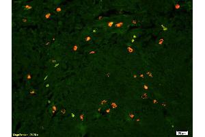 Formalin-fixed and paraffin embedded human glioma tissue labeled with Anti Lyn Polyclonal Antibody, PE conjugated (ABIN681493) at 1:200 dilution for 60 minutes at 37°C.