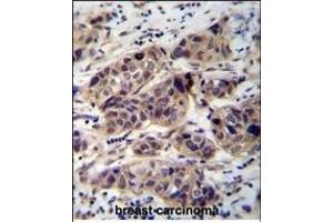 WDR42C Antibody (N-term) (ABIN655843 and ABIN2845256) immunohistochemistry analysis in formalin fixed and paraffin embedded human breast carcinoma followed by peroxidase conjugation of the secondary antibody and DAB staining. (DCAF8L2 anticorps  (N-Term))