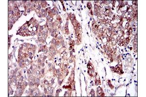 Immunohistochemical analysis of paraffin-embedded liver cancer tissues using SERPINA7 mouse mAb with DAB staining.