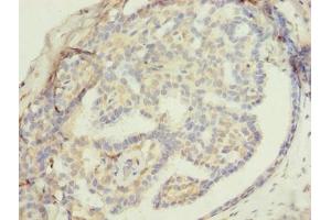 Immunohistochemistry of paraffin-embedded human breast cancer using ABIN7176453 at dilution of 1:100