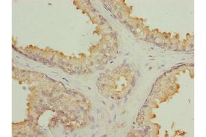 Immunohistochemistry of paraffin-embedded human prostate cancer using ABIN7145497 at dilution of 1:100 (GLB1L2 anticorps  (AA 401-636))