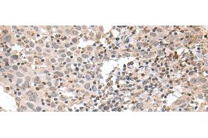 Immunohistochemistry of paraffin-embedded Human cervical cancer tissue using TDP2 Polyclonal Antibody at dilution of 1:75(x200) (TDP2 anticorps)