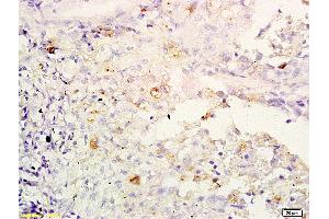 Formalin-fixed and paraffin embedded human lung carcinoma labeled with Anti-IL-32/NK4 Polyclonal Antibody, Unconjugated (ABIN748298) at 1:200 followed by conjugation to the secondary antibody and DAB staining (IL32 anticorps  (AA 151-234))